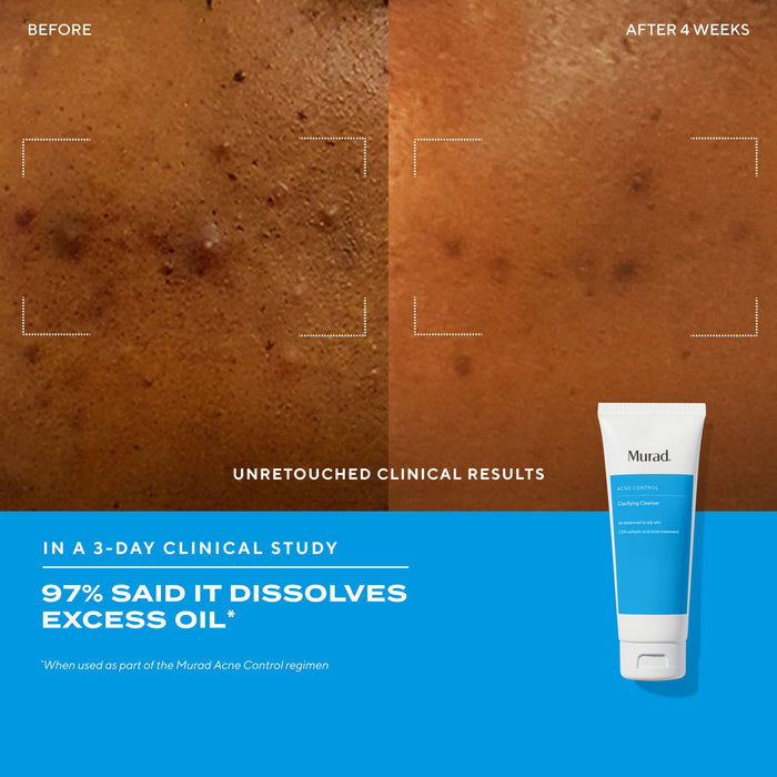 before and after close up of cheek showing improved breakouts after 4 week with text highlighting 97% said it dissolves excess oil