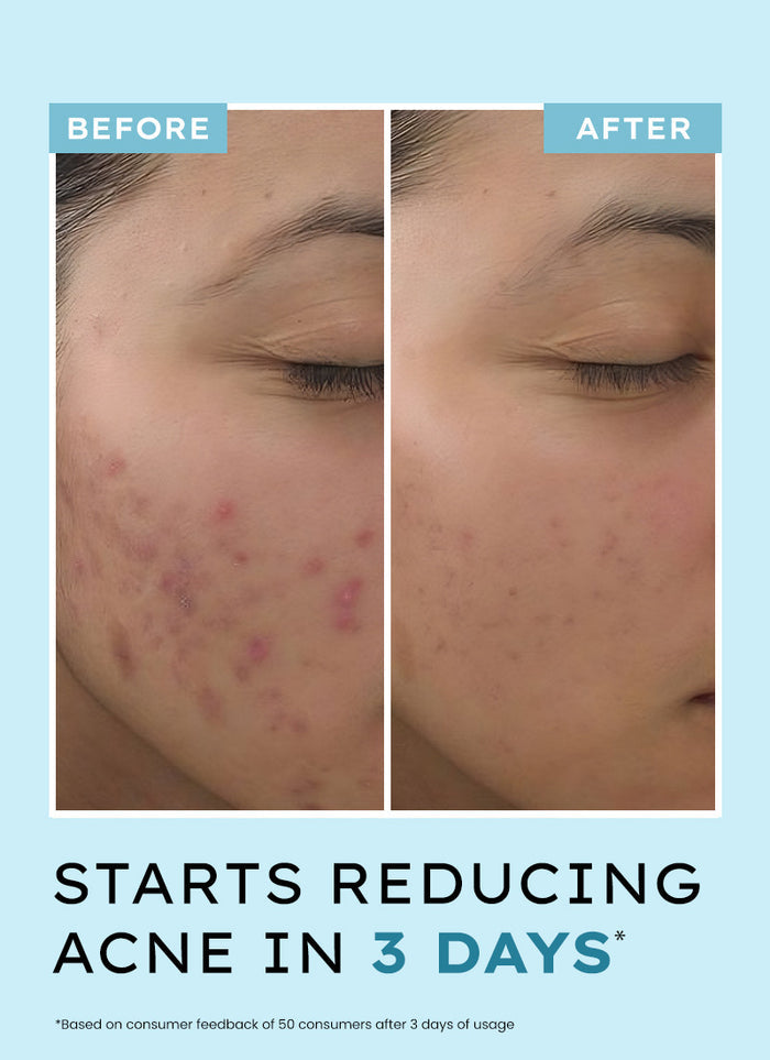 Hyphen Anti Acne Face Serum with 10% Azelaic Acid & 2% Salicylic Acid - how to use directions and skincare routine fit