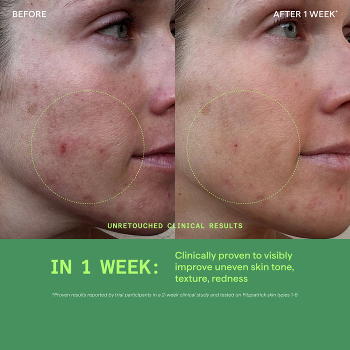 Before and after comparison of skin treatment showing reduced acne and redness.
