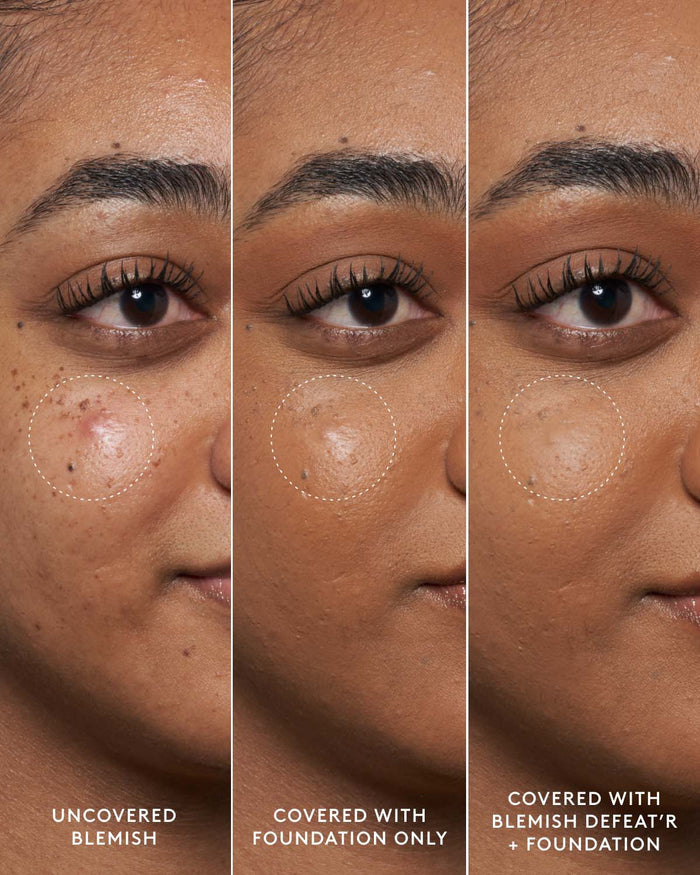 Close-up of model's medium-toned face showing an uncovered blemish, a foundation-covered blemish and a foundation and Blemish Defeat'r BHA Spot-Targeting Gel-covered blemish.