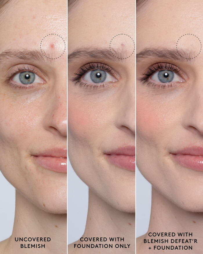 Close-up of model's light-toned face showing an uncovered blemish, a foundation-covered blemish and a foundation and Blemish Defeat'r BHA Spot-Targeting Gel-covered blemish.