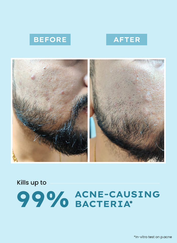 Hyphen Clarifying Acne Cleanser with 2% Salicylic Acid - clinical results chart and benefit claims