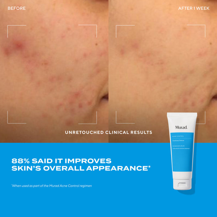 before and after close up of cheek showing less breakouts after 1 week with text highlighting 88% said it improves skin's overall appearance