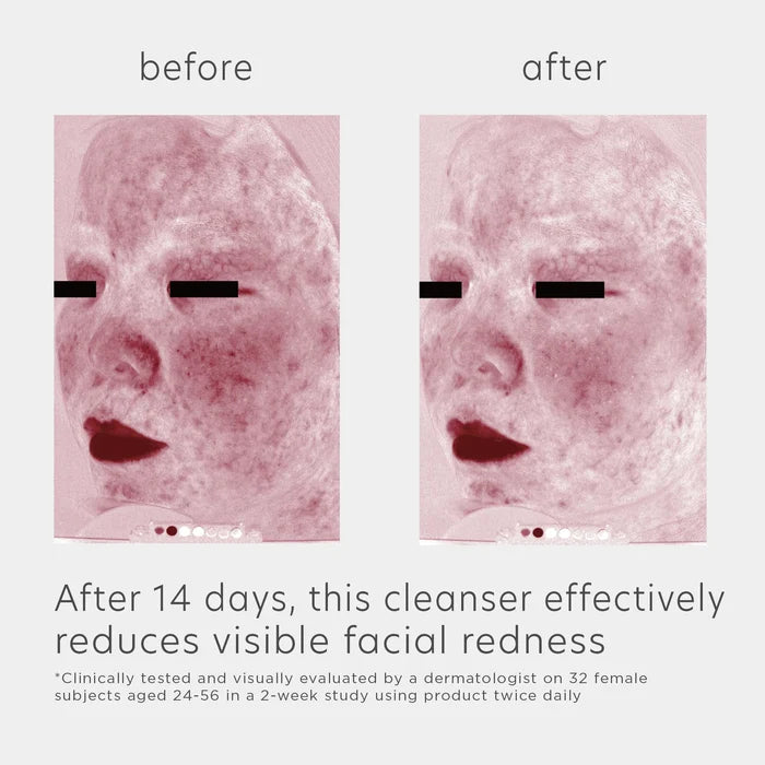 Before and after facial redness results after 14 days using EltaMD Skin Recovery Amino Acid Foaming Cleanser