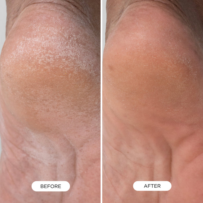 Before and after comparison of dry, rough heel skin showing visibly smoother and more hydrated results after using Foot Smooth.