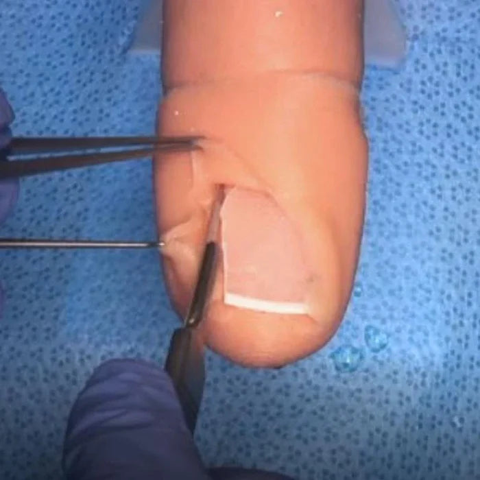 Ingrown Toenail Surgical Simulator (Onychocryptosis)
