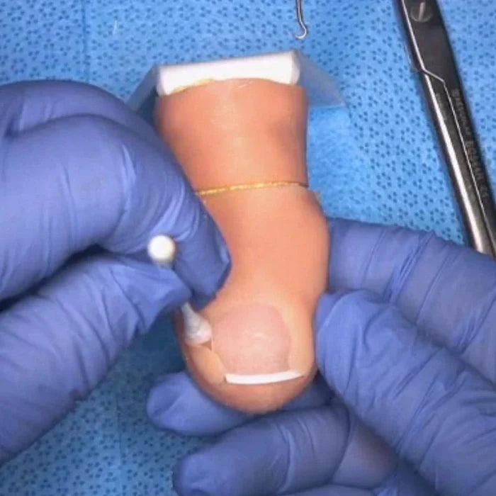 Ingrown Toenail Surgical Simulator (Onychocryptosis)