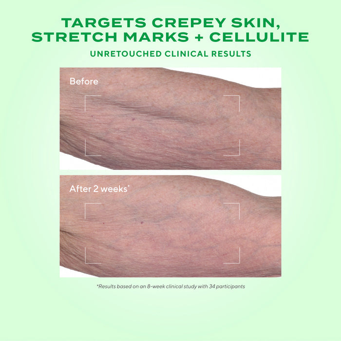 Retinal Resculpt Body Treatment before and after over 2 weeks showing mature arm with less wrinkles over time