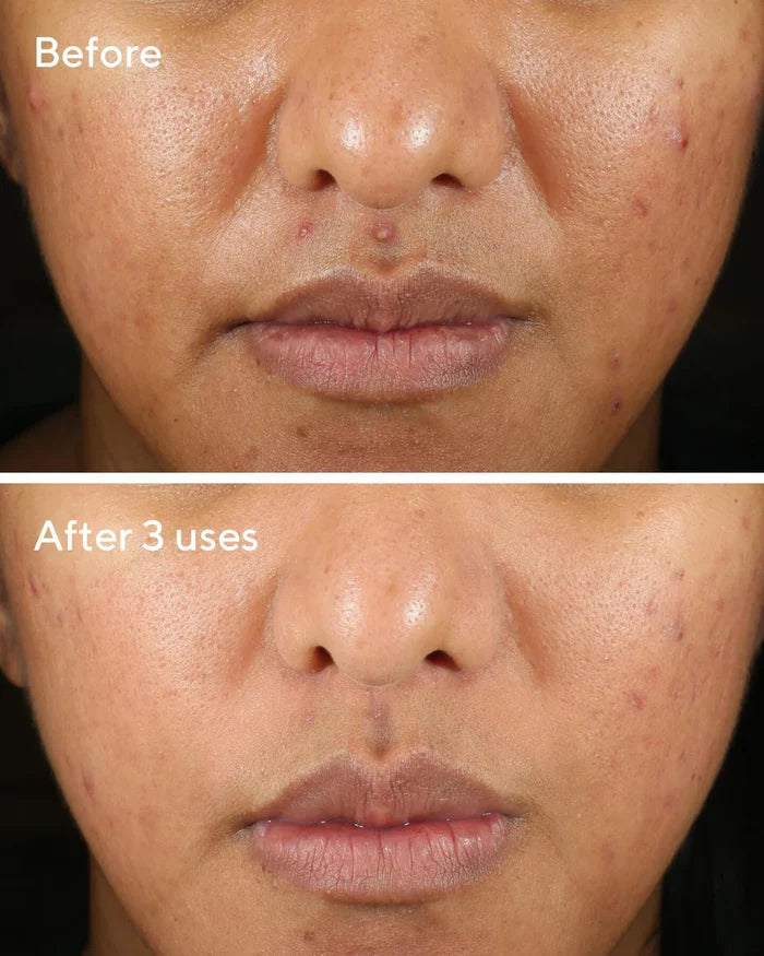 Murad Rapid Relief Acne Sulfur Mask