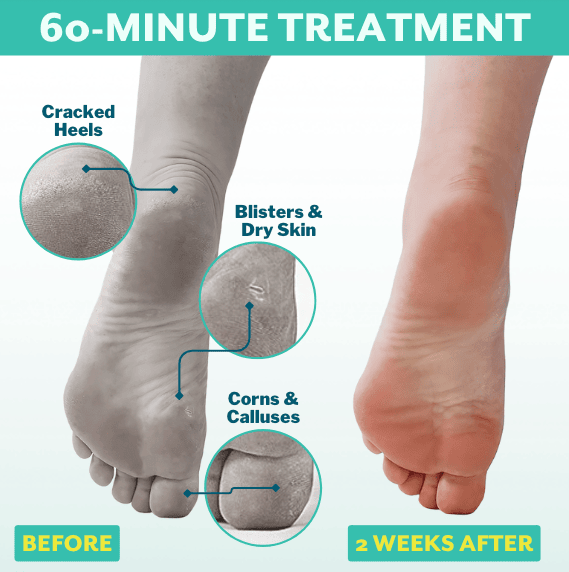 Before and after foot peel treatment showing smoother heels after two weeks.