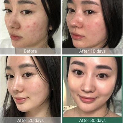 SOME BY MI AHA BHA PHA 30 Days Miracle Toner تونر البشرة المعجزة لعلاج الحبوب من سمباي مي